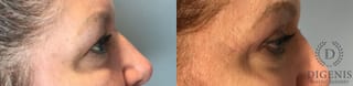 Before and after Eye Lid Surgery case 41693 - Angle 3