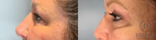 Before and after Eye Lid Surgery case 41693 - Angle 5