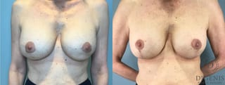 Before and after Breast Lift with or without Implants case 41688 - Angle 1