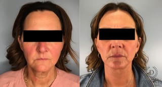 Before and after Face Lift/Neck Lift case 41696 - Angle 1