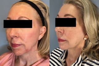 Before and after Temple Lift case 41711 - Angle 2