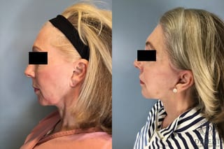 Before and after Temple Lift case 41711 - Angle 3