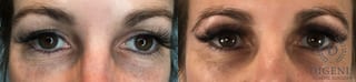 Before and after Eye Lid Surgery case 41732 - Angle 1