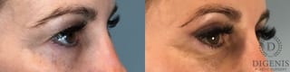 Before and after Eye Lid Surgery case 41732 - Angle 2