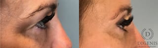 Before and after Eye Lid Surgery case 41732 - Angle 3