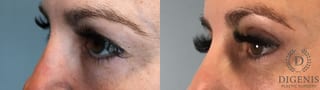 Before and after Eye Lid Surgery case 41732 - Angle 4