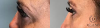 Before and after Eye Lid Surgery case 41732 - Angle 5