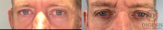 Before and after Eye Lid Surgery case 41739 - Angle 1