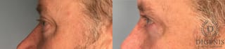 Before and after Eye Lid Surgery case 41739 - Angle 2