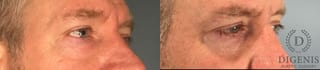 Before and after Eye Lid Surgery case 41739 - Angle 3