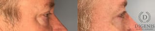 Before and after Eye Lid Surgery case 41739 - Angle 4