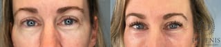 Before and after Laser Skin Resurfacing case 41760 - Angle 1