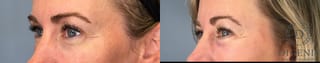 Before and after Laser Skin Resurfacing case 41760 - Angle 2
