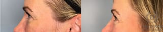 Before and after Laser Skin Resurfacing case 41760 - Angle 3