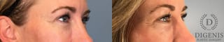 Before and after Laser Skin Resurfacing case 41760 - Angle 4