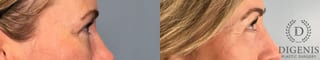 Before and after Laser Skin Resurfacing case 41760 - Angle 5