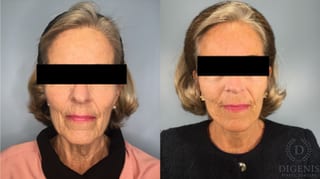 Before and after Face Lift/Neck Lift case 41847 - Angle 1