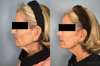 Before and after Face Lift/Neck Lift case 41847 - Angle 2