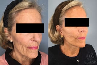 Before and after Face Lift/Neck Lift case 41847 - Angle 3