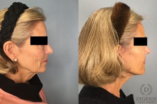 Before and after Face Lift/Neck Lift case 41847 - Angle 4