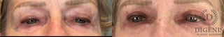 Before and after Eye Lid Surgery case 41850 - Angle 1