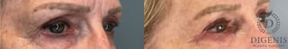 Before and after Eye Lid Surgery case 41850 - Angle 2