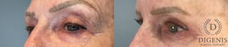 Before and after Eye Lid Surgery case 41850 - Angle 3