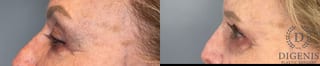 Before and after Eye Lid Surgery case 41850 - Angle 4