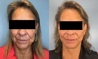 Before and after Face Lift/Neck Lift case 41925 - Angle 1