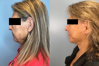 Before and after Face Lift/Neck Lift case 41925 - Angle 2