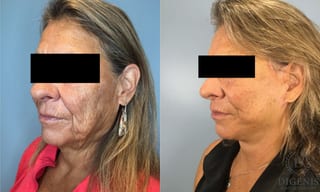 Before and after Face Lift/Neck Lift case 41925 - Angle 3