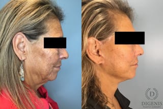 Before and after Face Lift/Neck Lift case 41925 - Angle 4