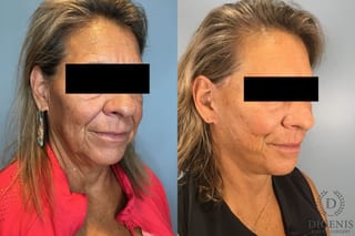 Before and after Face Lift/Neck Lift case 41925 - Angle 5