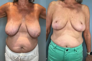 Before and after Breast Lift with or without Implants case 43072 - Angle 1