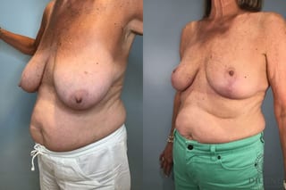 Before and after Breast Lift with or without Implants case 43072 - Angle 2