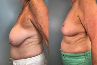 Before and after Breast Lift with or without Implants case 43072 - Angle 3