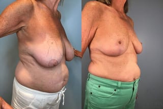 Before and after Breast Lift with or without Implants case 43072 - Angle 4