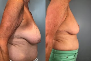Before and after Breast Lift with or without Implants case 43072 - Angle 5
