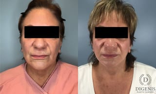 Before and after Face Lift/Neck Lift case 43074 - Angle 1