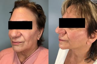 Before and after Face Lift/Neck Lift case 43074 - Angle 2