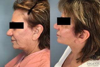 Before and after Face Lift/Neck Lift case 43074 - Angle 3
