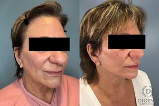 Before and after Face Lift/Neck Lift case 43074 - Angle 4