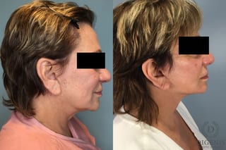 Before and after Face Lift/Neck Lift case 43074 - Angle 5
