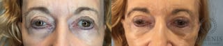 Before and after Eye Lid Surgery case 43075 - Angle 1