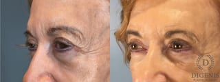 Before and after Eye Lid Surgery case 43075 - Angle 2