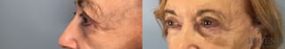 Before and after Eye Lid Surgery case 43075 - Angle 3