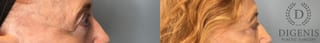 Before and after Eye Lid Surgery case 43075 - Angle 4