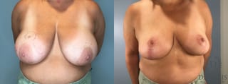 Before and after Breast Lift with or without Implants case 43076 - Angle 1