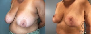 Before and after Breast Lift with or without Implants case 43076 - Angle 2