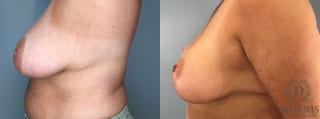 Before and after Breast Lift with or without Implants case 43076 - Angle 3
